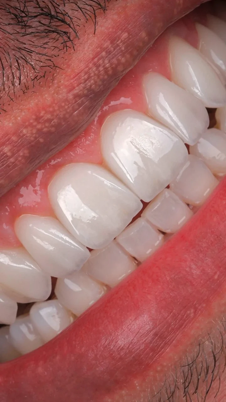 Detalhe clínico de lentes de contato dental